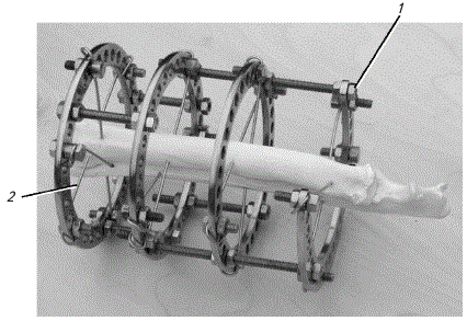 Схема фиксации костей аппаратом Илизарова