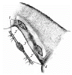 Схема резекции яремной вены