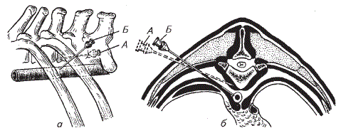 Положение иглы при пункции брюшной аорты (по И. И. Воронину)