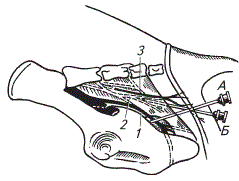 Положение иглы при внутритазовой анестезии пениса у хряка
