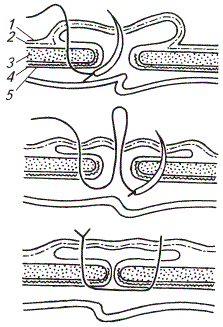 Схема наложения петлевидного горизонтального шва на грыжевое кольцо по Р.А. Сунагатуллину