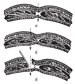Схема разрезов нижней брюшной стенки