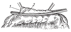 Наложение изогнутого зажима по продольной оси кишки
