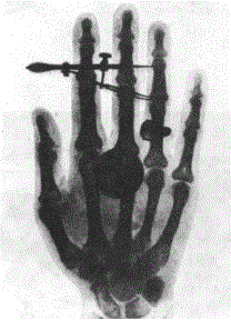 Один из первых рентгеновских снимков